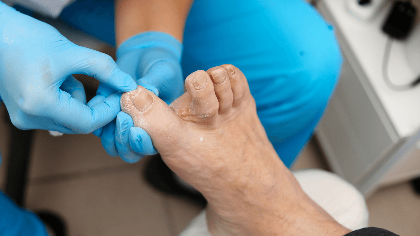 Ingrown Toenails